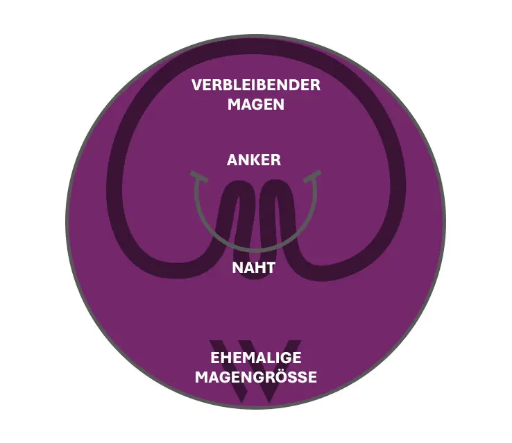 pose-3-0-Double-Helix-Endo-Sleeve-0